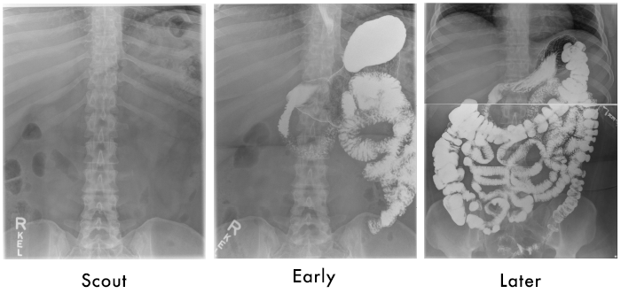 Fluoro GI Tract Small bowel